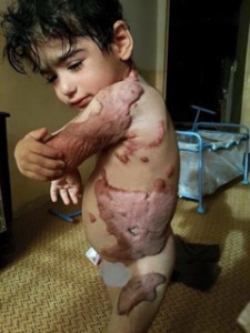 hamza burned by israel